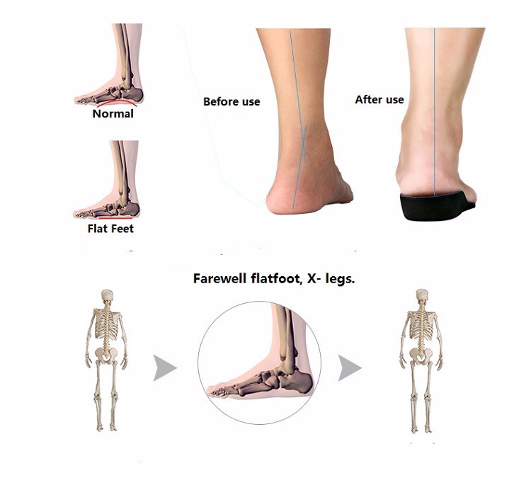 come4buy.com-Flat Feet Arch Support Insoles Orthopedic